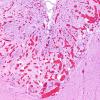 3C7 Encephalocele, Meckel-Gruber syndrome (Case 3) N3 H&E 3