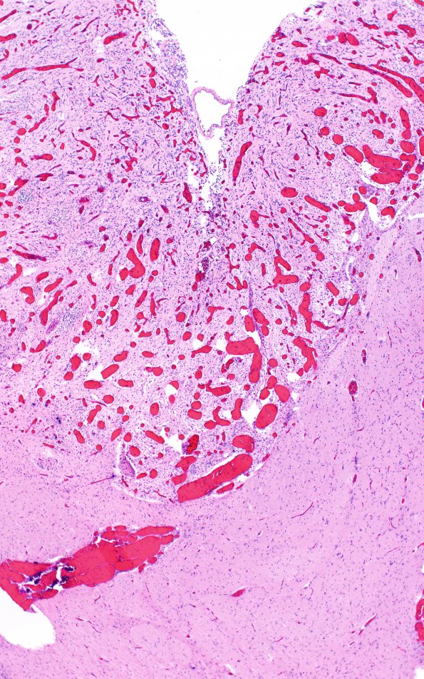 3C7 Encephalocele, Meckel-Gruber syndrome (Case 3) N3 H&E 3