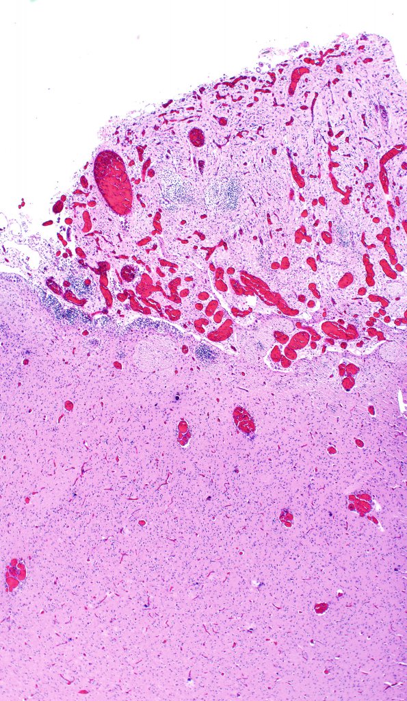 3C8 Encephalocele, Meckel-Gruber syndrome (Case 3) N5 H&E 1