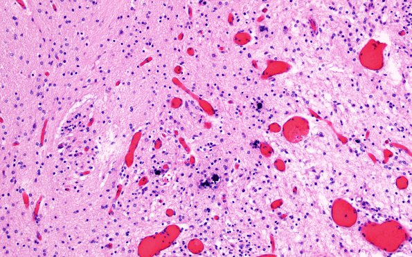 3C9 Encephalocele, Meckel-Gruber syndrome (Case 3) N3 H&E 1