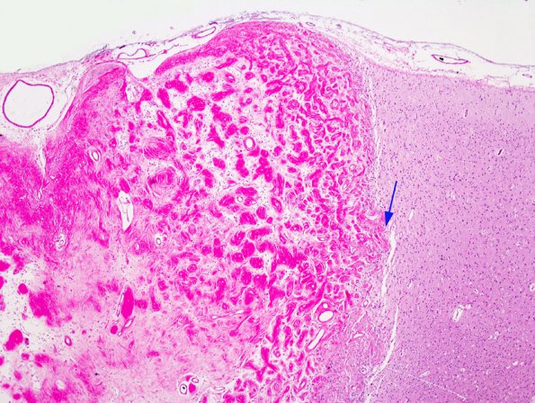 1A1 Meningioangiomatosis (Case 1) 1