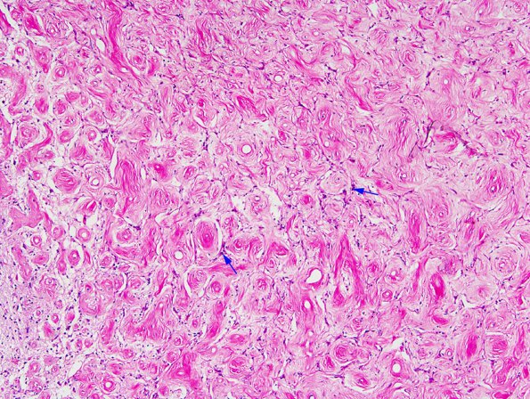 1A2 Meningioangiomatosis (Case 1) 2