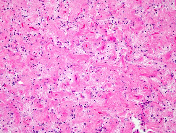 2A2 Meningioangiomatosis (Case 2) 4