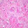 2A3 Meningioangiomatosis (Case 2) 1 copy