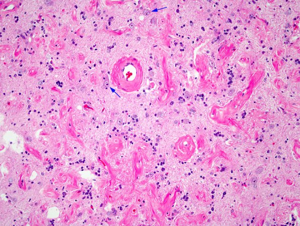 2A3 Meningioangiomatosis (Case 2) 1 copy