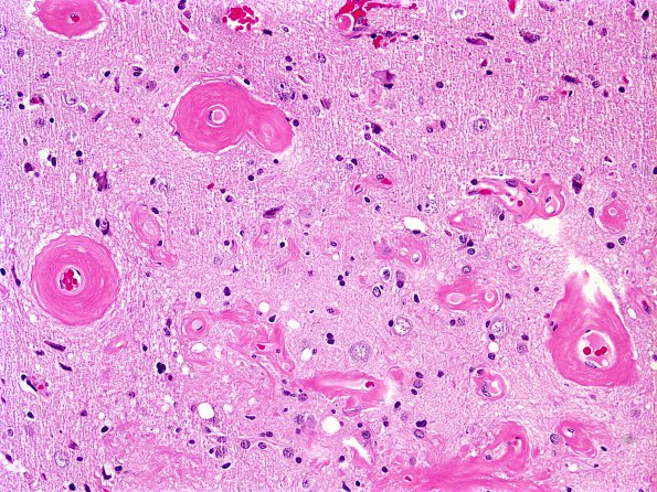 2A4 Meningioangiomatosis (Case 2) 6