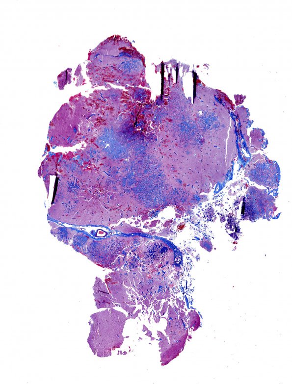 2B1 Meningioangiomatosis (Case 2) Trichrome