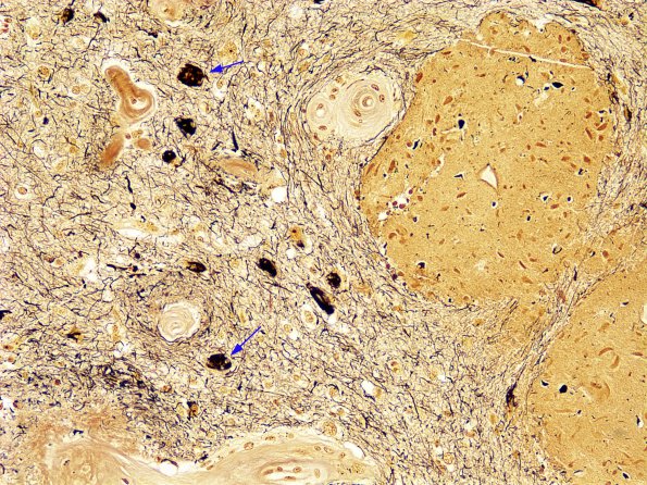 2B11 Meningioangiomatosis (Case 2) Biels 1