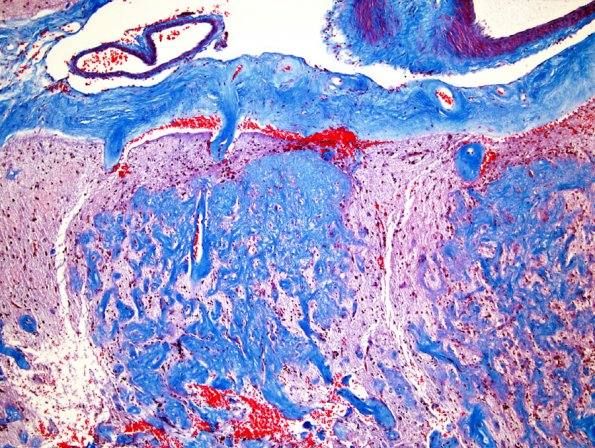 2B2 Meningioangiomatosis (Case 2) Trichrome 1