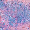 2B3 Meningioangiomatosis (Case 2) Trichrome 2