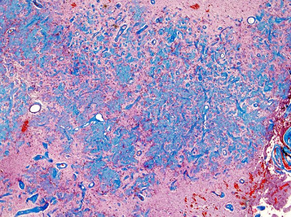 2B3 Meningioangiomatosis (Case 2) Trichrome 2