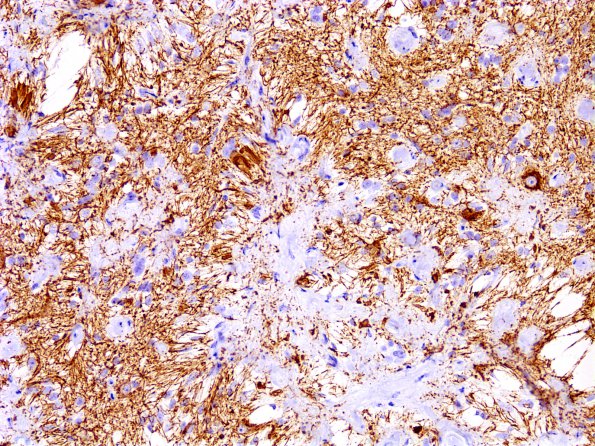 2B5 Meningioangiomatosis (Case 2) NFil 3