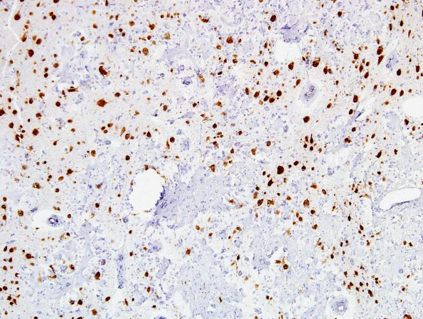 2B6 Meningioangiomatosis (Case 2) NeuN 10X A