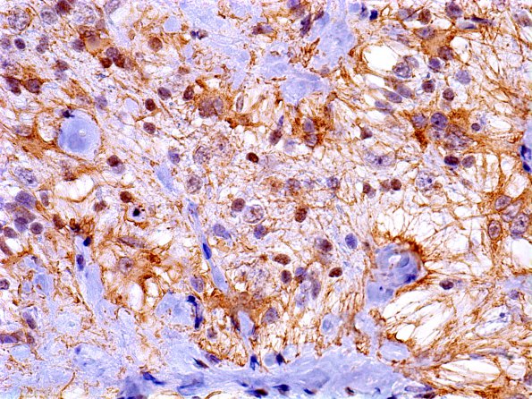 2B8 Meningioangiomatosis (Case 2) GFAP 2