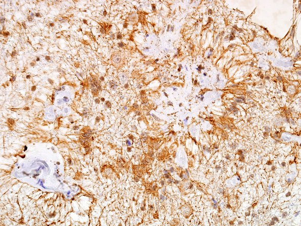 2B9 Meningioangiomatosis (Case 2) GFAP 40X