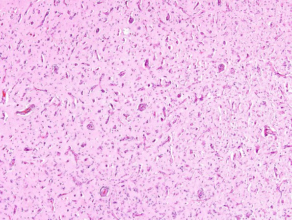 3A1 Meningioangiomatosis (Case 3) H&E 5A
