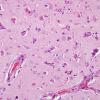 3A2 Meningioangiomatosis (Case 3) H&E 1