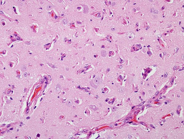 3A2 Meningioangiomatosis (Case 3) H&E 1