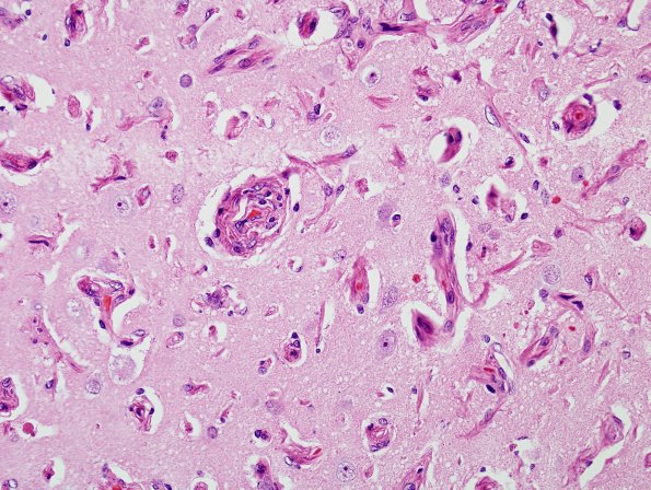 3A3 Meningioangiomatosis (Case 3) H&E 3