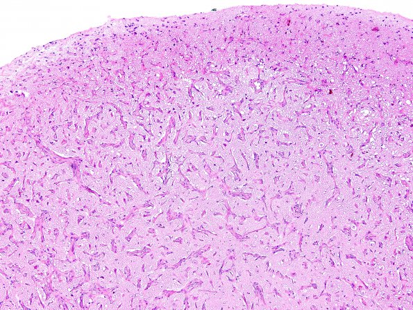 4A1 Meningioangiomatosis (Case 4) H&E 10X 1