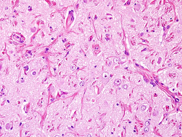 4A2 Meningioangiomatosis (Case 4) H&E 2