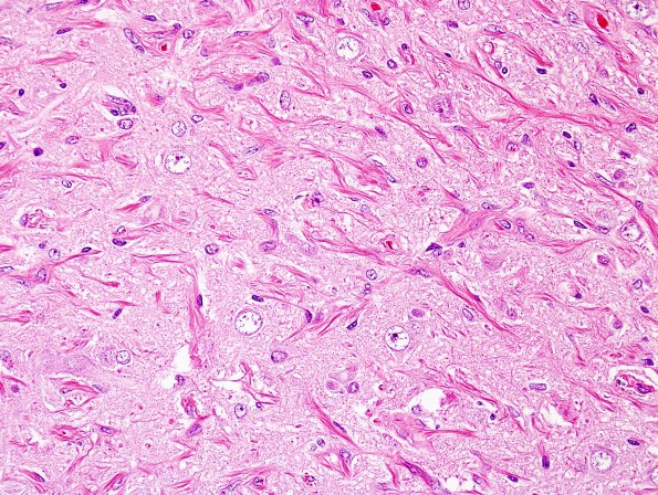 4A3 Meningioangiomatosis (Case 4) H&E 1