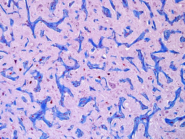 4B2 Meningioangiomatosis (Case 4) trichrome 1