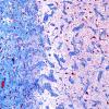 4B3 Meningioangiomatosis (Case 4) trichrome 2