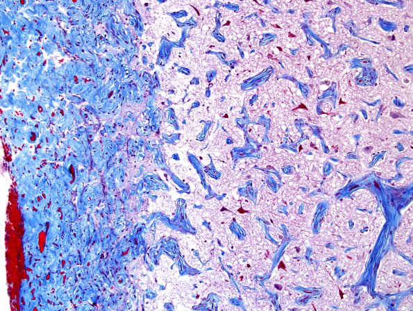 4B3 Meningioangiomatosis (Case 4) trichrome 2
