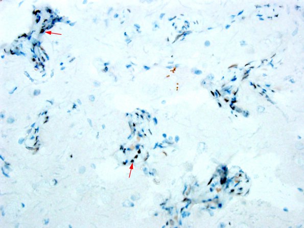 4B4 Meningioangiomatosis (Case 4) PR 1A