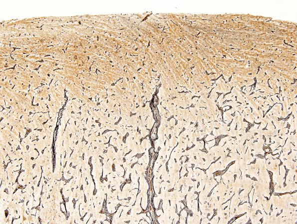 4B7 Meningioangiomatosis (Case 4) Biels 10X