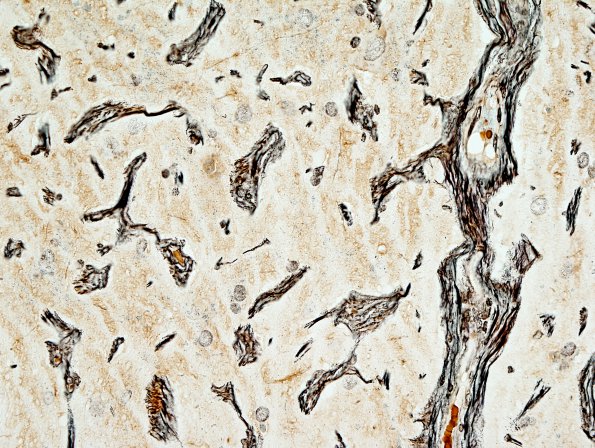 4B8 Meningioangiomatosis (Case 4) Biels 40X