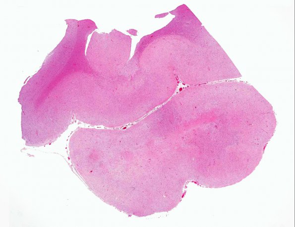 5A1 Meningoangiomatosis (AANP 2000, Case 4) H&E X whole mount