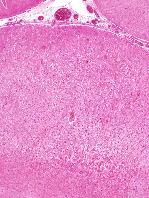 5A2 Meningoangiomatosis (AANP 2000-Case 4) H&E 9