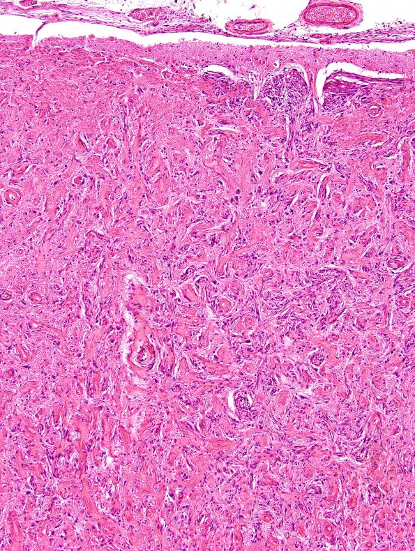 5A3 Meningoangiomatosis (AANP 2000-Case 4) H&E 10