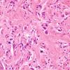 5A5 Meningoangiomatosis  (AANP 2000-Case 4) H&E 2