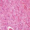 5A6 Meningoangiomatosis (AANP 2000-Case 4) H&E 4