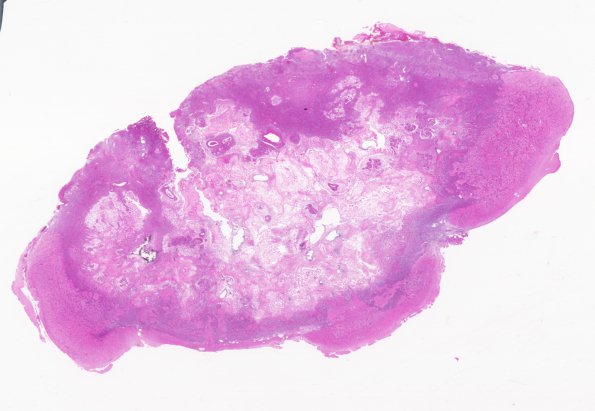 6A1 Meningioangiomatosis (Case 6) H&E whole mount