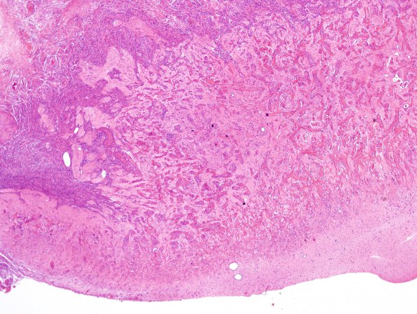 6A2 Meningioangiomatosis (Case 6) H&E 2