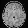 7A1 Meningioangiomatosis (Case 7) T2 FLAIR 2 copy - Copy