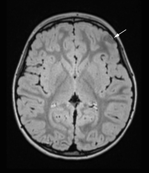 7A1 Meningioangiomatosis (Case 7) T2 FLAIR 2 copy - Copy