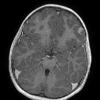 7A2 Meningioangiomatosis (Case 7) T1W 2 axial - Copy