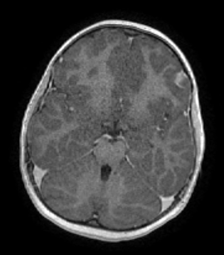 7A2 Meningioangiomatosis (Case 7) T1W 2 axial - Copy