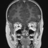 7A3 Meningoangiomatosis (Case 7) T1W 1 coronal - Copy