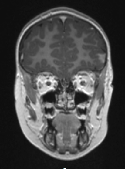 7A3 Meningoangiomatosis (Case 7) T1W 1 coronal - Copy