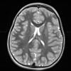 7A4 Meningoangiomatosis (Case 7) T2W - Copy