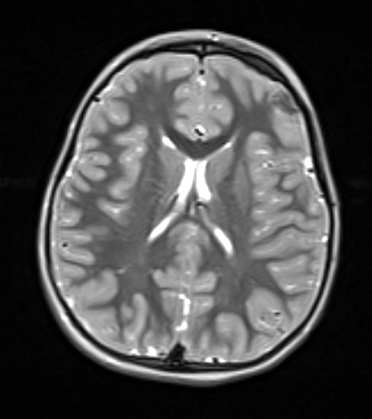 7A4 Meningoangiomatosis (Case 7) T2W - Copy