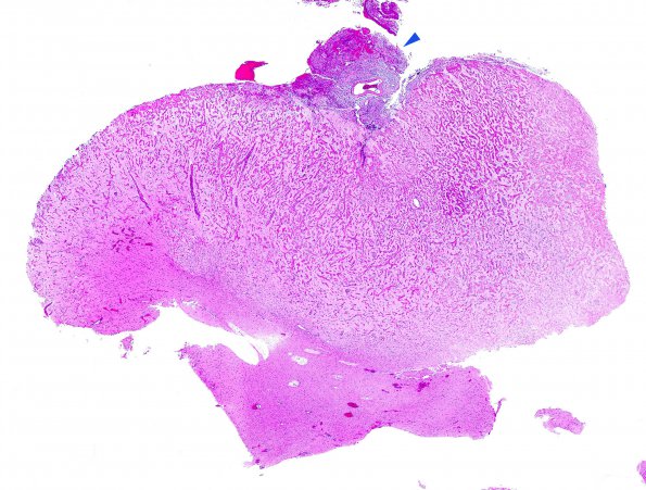 7B1 Meningioangiomatosis (Case 7) H&E WM copy