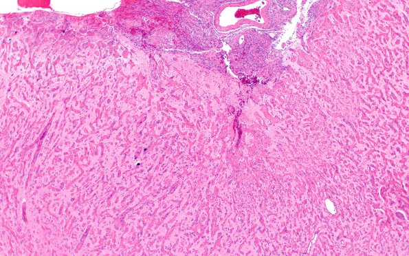 7B2 Meningoangiomatosis (Case 7) H&E 4X