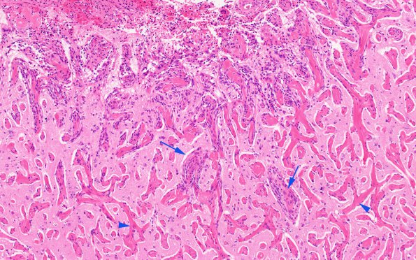 7B3 Meningoangiomatosis (Case 7) H&E B3 10X copy